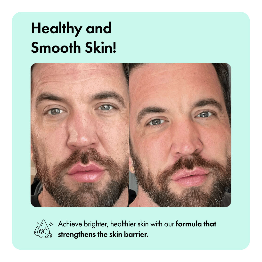 Anti-Acne Cleansing Bar